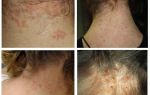 Comment mordre les poux de lin, les morsures de photos