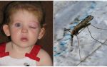 Que faire si un enfant a les yeux gonflés après une piqûre de moustique
