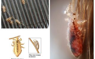 Période d'incubation des poux et des lentes chez l'homme