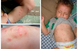 À quoi ressemblent les piqûres d'insectes chez un enfant