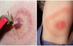 Qu'est-ce que la maladie de Lyme, ses symptômes, son traitement et sa photo