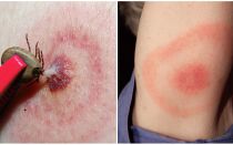 Qu'est-ce que la maladie de Lyme, ses symptômes, son traitement et sa photo
