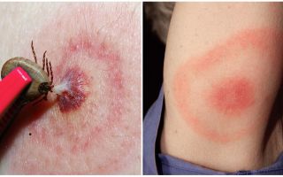 Qu'est-ce que la maladie de Lyme, ses symptômes, son traitement et sa photo