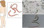Quels sont les oxyures et à quoi ils ressemblent