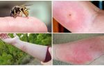 Que faire si une guêpe ou un mors d'abeille