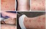 Comment les piqûres de puces sur la peau humaine photo