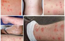 Comment les piqûres de puces sur la peau humaine photo