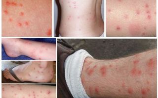Comment les piqûres de puces sur la peau humaine photo