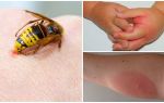 Réaction allergique à la piqûre de guêpe