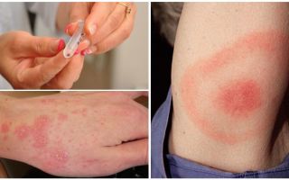 Maladies des morsures de tiques chez l'homme