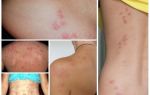 Que sont les insectes dangereux et leurs piqûres?