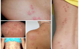 Que sont les insectes dangereux et leurs piqûres?