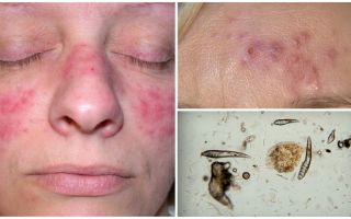 Tique sous-cutanée sur le visage