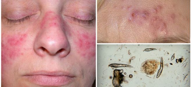 Tique sous-cutanée sur le visage