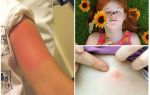 Que faire si un enfant est mordu par une abeille