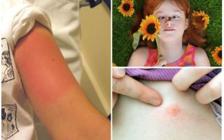 Que faire si un enfant est mordu par une abeille