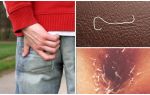 Les meilleurs médicaments pour le traitement des oxyures