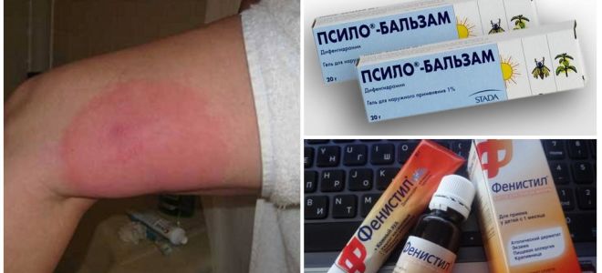 Que faire si, après la piqûre d'un moustique, la jambe est gonflée