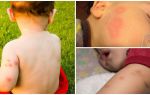 Fonds pour les enfants après les piqûres de moustiques