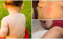 Fonds pour les enfants après les piqûres de moustiques