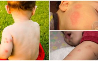 Fonds pour les enfants après les piqûres de moustiques