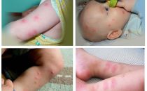 Que faire si un enfant est piqué par une puce, une photo pique