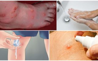 Pourquoi une ampoule apparaît-elle après une piqûre de moustique?