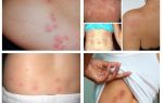 À quoi ressemblent les piqûres de punaises de lit sur la peau humaine?