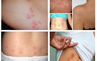 À quoi ressemblent les piqûres de punaises de lit sur la peau humaine?