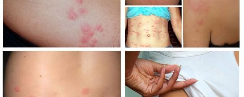À quoi ressemblent les piqûres de punaises de lit sur la peau humaine?