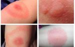 Morsures de moucherons sur une personne et traitement