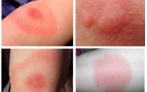 Morsures de moucherons sur une personne et traitement