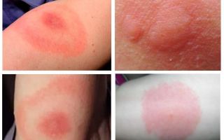Morsures de moucherons sur une personne et traitement