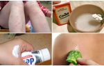 Comment enlever les taches rouges des piqûres de moustiques