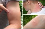 Comment enlever le gonflement et les démangeaisons des piqûres de moustiques chez un enfant et un adulte