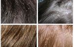 Poux de tête dans les cheveux des enfants