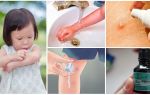 Comment et quoi traiter les piqûres de moustiques chez un enfant