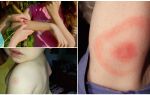 Symptômes et traitement des morsures de tiques chez un enfant