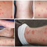 Les piqûres de puces sur le corps