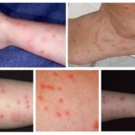 Morsures de puces de chien