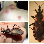 Piqûres d'insectes triatom