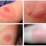 Allergie à la morsure de merle noir