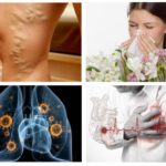 Allergie, maladie cardiaque, tuberculose