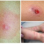 Allergie aux cafards