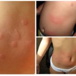 Allergique aux piqûres de puces