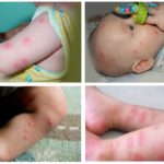 Piqûres de puces chez un enfant