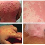 Allergie aux piqûres de punaises