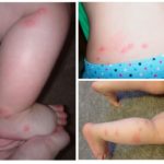 Les piqûres de punaises chez les enfants-1