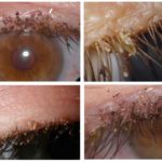 Poux sur les cils
