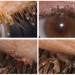Poux sur les cils